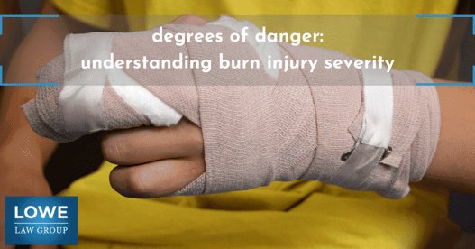 man with a burn injury on hand