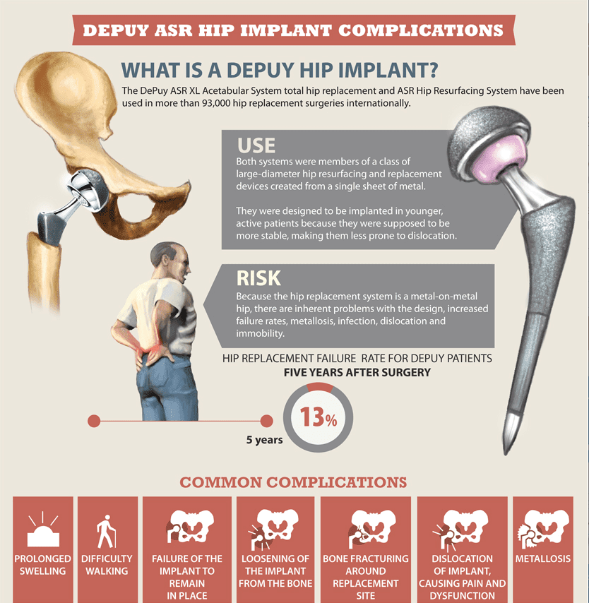 What is a Depuy Hip Implant? Infographic